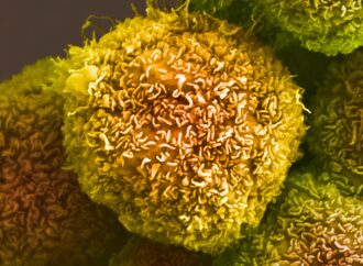 Exploring the Search for a Pancreatic Cancer Cure