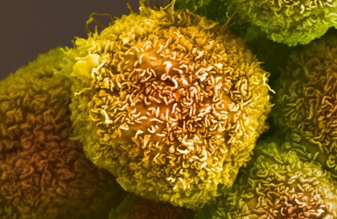 Exploring the Search for a Pancreatic Cancer Cure