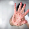 Recognizing Measles Symptoms: An Essential Guide