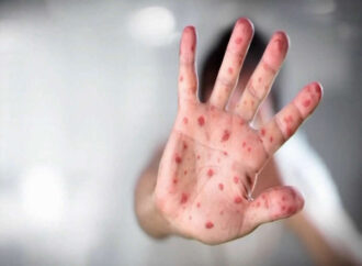 Recognizing Measles Symptoms: An Essential Guide
