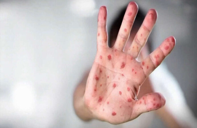 Recognizing Measles Symptoms: An Essential Guide