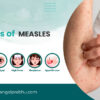 Understanding Measles Symptoms and Their Importance
