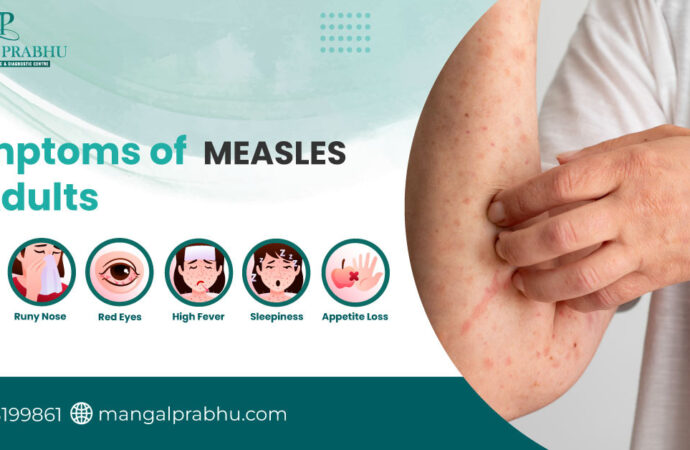 Understanding Measles Symptoms and Their Importance