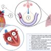What You Need to Know About Pulmonary Embolism