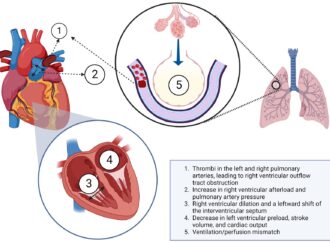 What You Need to Know About Pulmonary Embolism