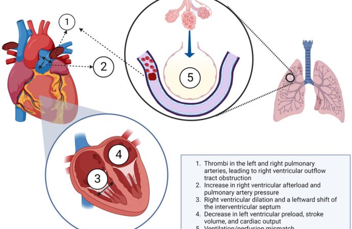 What You Need to Know About Pulmonary Embolism
